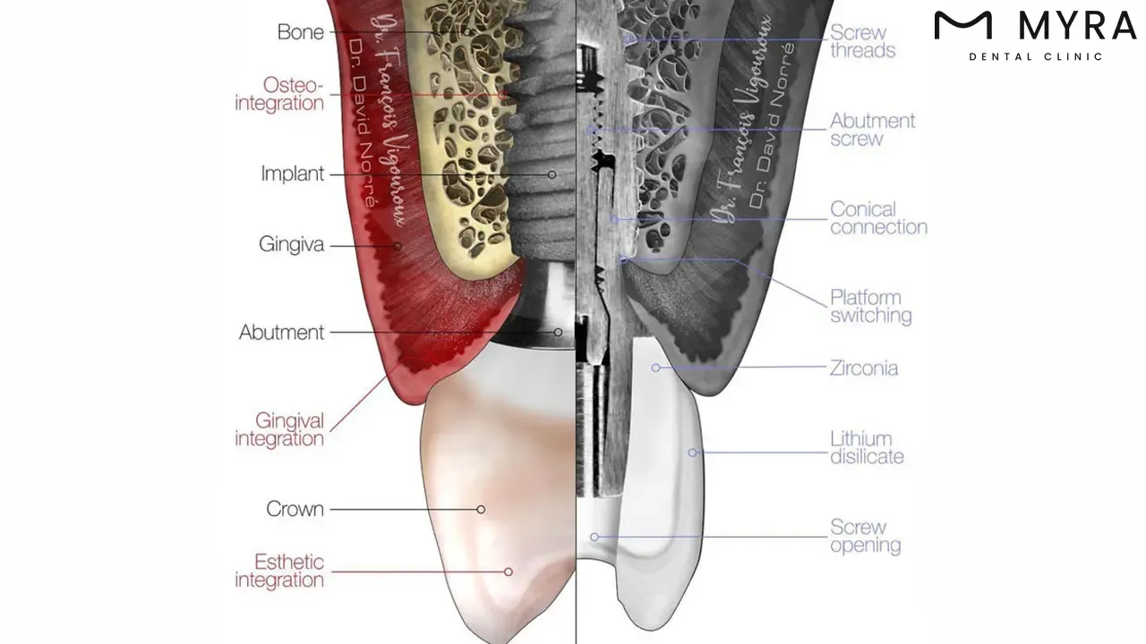 Are there guidelines regarding the maximum quantity of dental implants_.webp